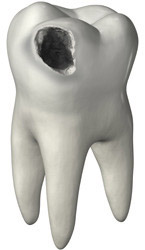пораженный кариесом зуб
