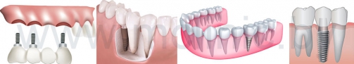 схематическое изображение зубных имплантантов