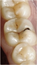 развитие кариеса на зубе