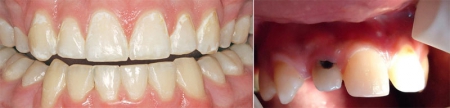 фотография зубов пораженных пришеечным кариесом на разных стадиях