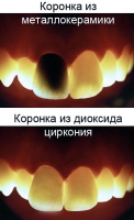 светопропускаемость коронки из металлокерамики и диоксида циркония