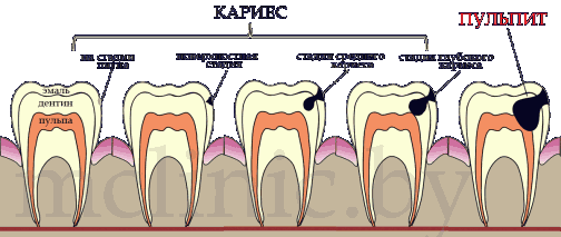 стадии развития кариеса вплоть до пульпита