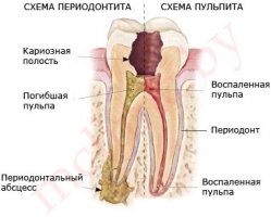 схема развития периодонтита и пульпита