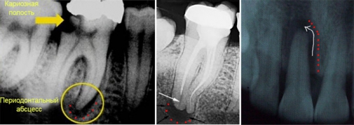 рентгеновские снимки с выявленным периодонтитом 
