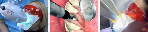 варианты профессионального отбеливания зубов